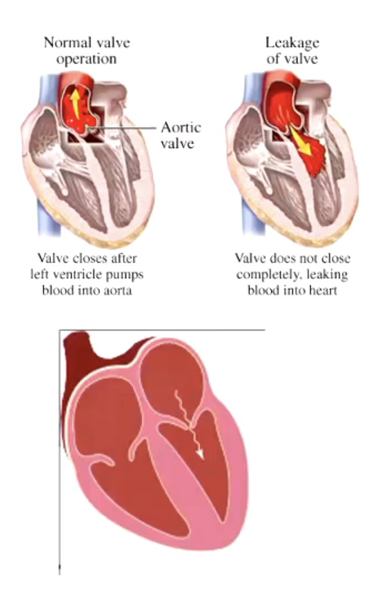 <ul><li><p>regurgitant flow through incompetent aortic or pulmonic valve</p></li><li><p>mitral or tricuspid stenosis</p></li></ul><p></p>