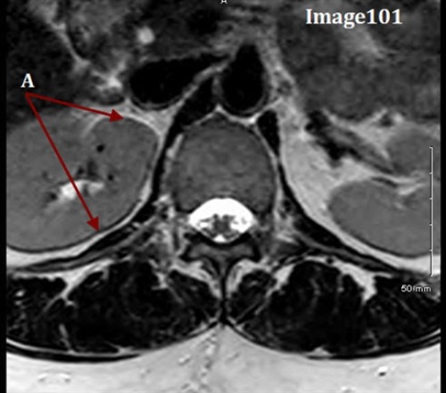 <p><span><strong>Letter A in Image 101 is pointing to what type of MR artifact?</strong></span></p>