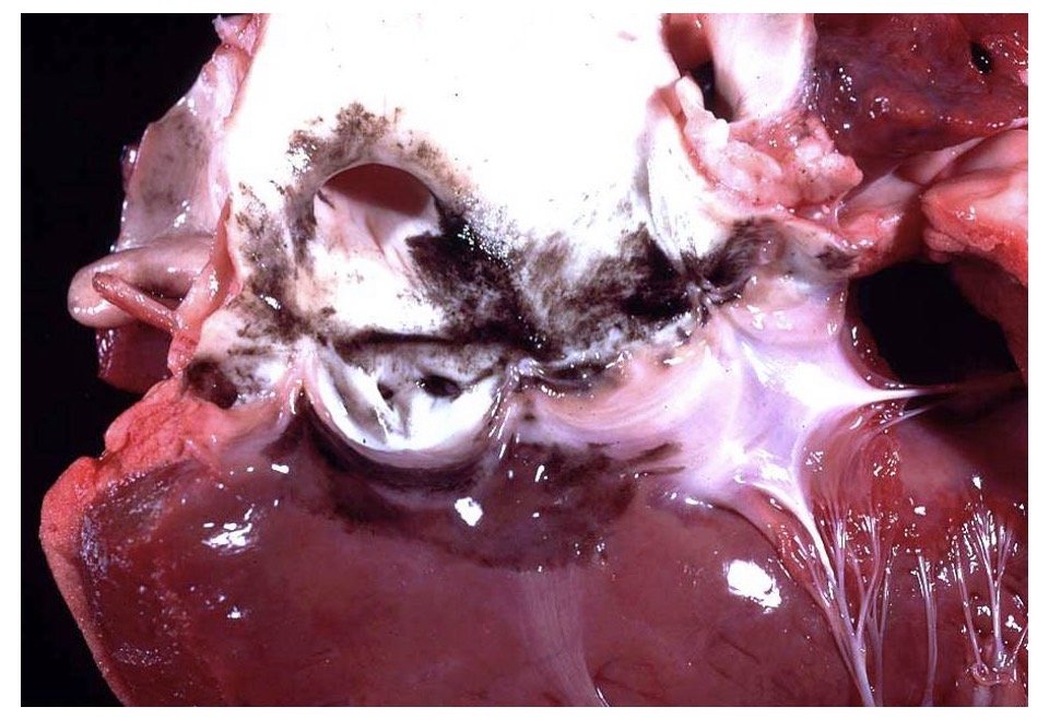 <p>endocardial diseases- pigmentation causes + effects</p>