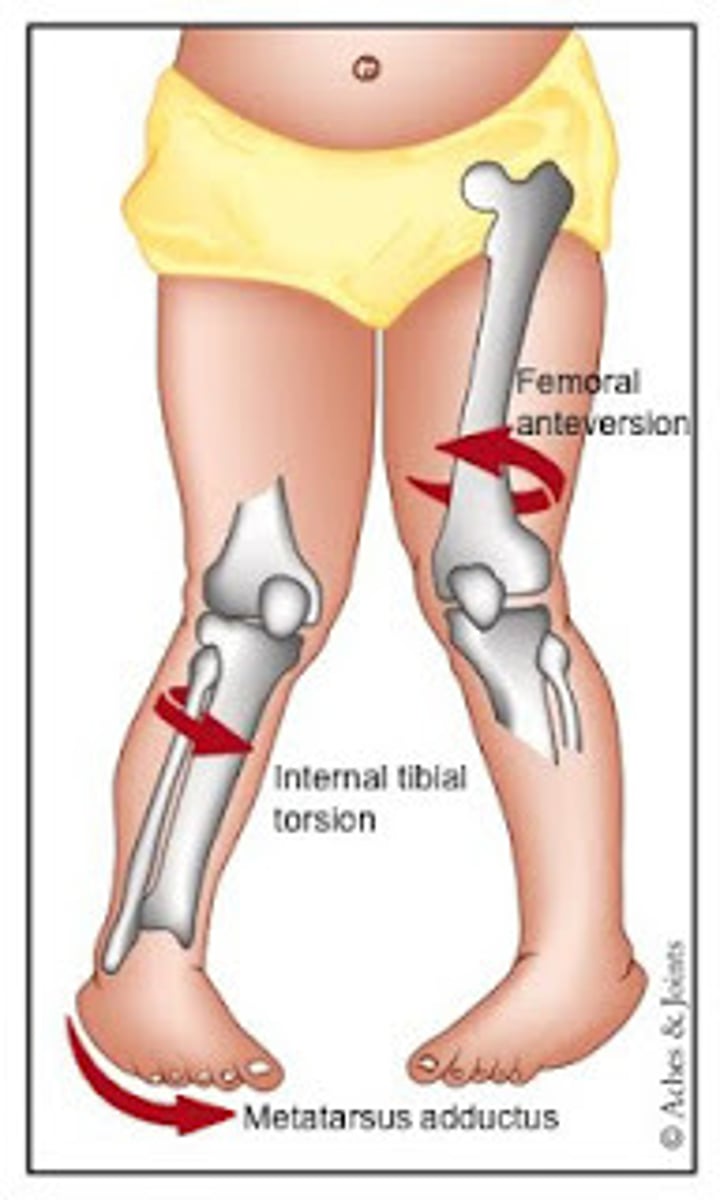 <p>hip anteversion</p>