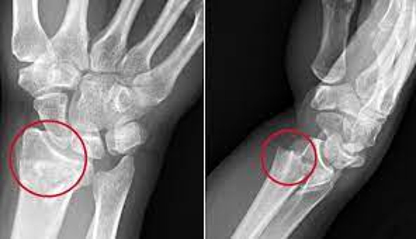 <p>FOOSH with extended wrist</p><p>pain of distal radius/wrist</p><p>radiographic findings - volar fracture angulation with dorsal proximal displacement or "dinner fork" deformity</p>