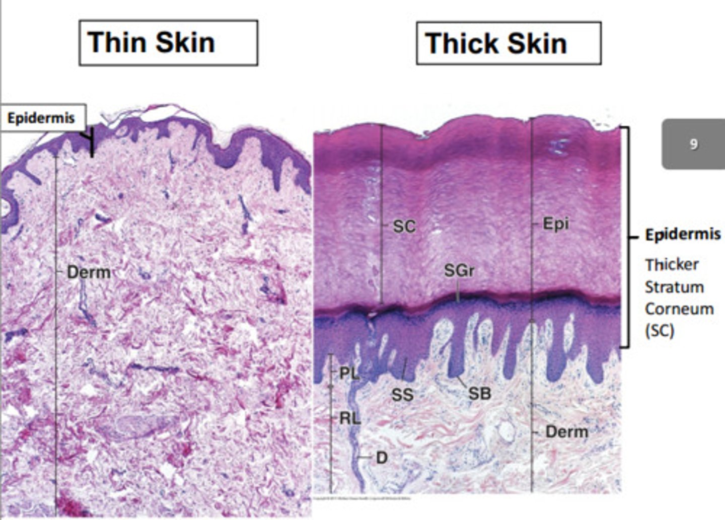 <p>- thin Skin (4 layers)</p><p>Less defined stratum corneum.</p><p>Less prominent rete ridges + dermal papillae.</p><p>Has hair follicles, sebaceous glands, arrector pili muscles.</p><p>Found most abundantly. </p><p>- thick skin (5 layers)</p><p>Stratum Lucidum present (an extra layers between the stratum granulosum and corneum).</p><p>More defined stratum corneum.</p><p>More prominent rete ridges + dermal papillae.</p><p>Hair and gland free. </p><p>Found on sole of feet + palm of hands.</p>