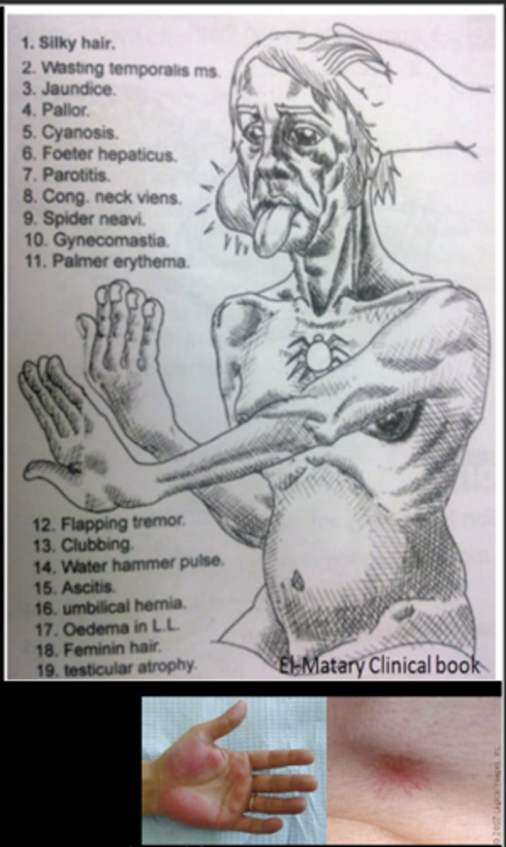 <p>Die within a few weeks or months</p><p>May be sudden injury or chronic injury</p><p>Loss of 90% of function</p><p>Clinically:</p><p>- jaundice</p><p>- ascites</p><p>- fetor hepaticus (ammonia and ketones in breath)</p><p>- hypoalbuminemia</p><p>- hypoglycemia</p><p>- palmar erythema</p><p>- spider angiomata</p><p>- testicular atrophy</p><p>- balding</p><p>- gynecomastia</p><p>- bleeding disorders</p><p>- hepatorenal syndrome</p><p>- hepatic encephalopathy (cells in the nervous system are vulnerable to neurotoxins absorbed from the GI tract that, due to liver dysfunction, circulate to the brain)</p>