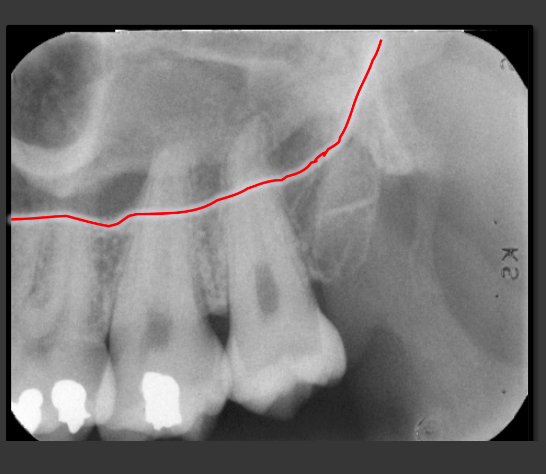 <p>It is a thin radio opaque line that travels low near the roots of the teeth.</p>