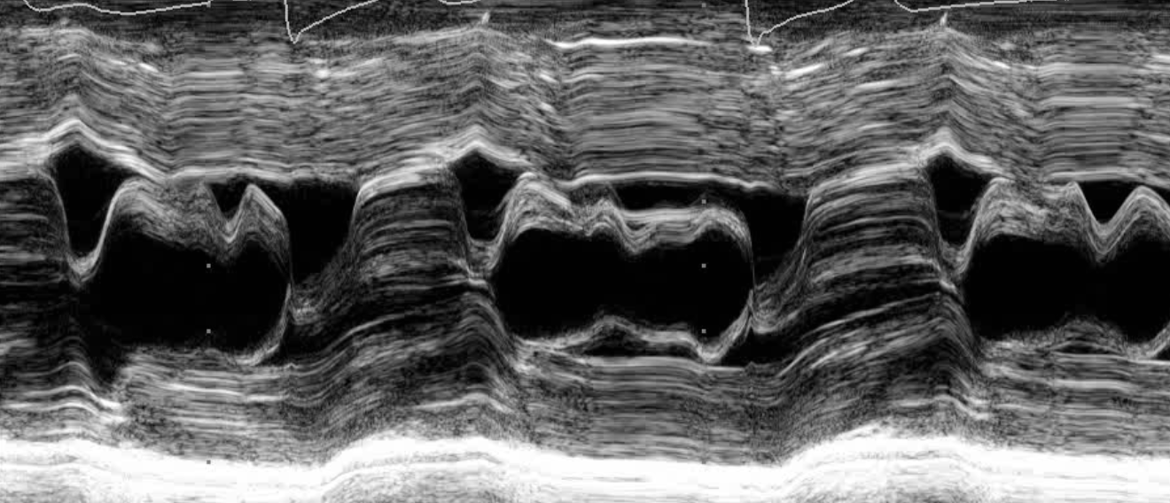 <p>obstruction of LVOT during systole due to hypertrophic cardiomyopathy</p>