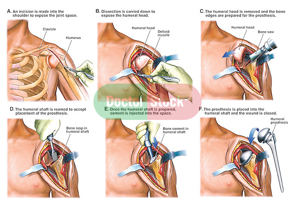<p>total shoulder arthroplasty procedure</p>