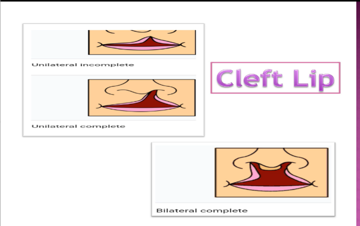 <ul><li><p>Unilateral incomplete </p></li><li><p>Unilateral complete </p></li><li><p>Bilateral complete</p></li></ul><p></p>