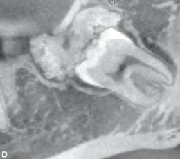 <p>irrregular mass with enamel density and lucent rim </p>