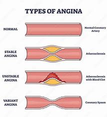 <p>What are the 3 types of angina?</p>