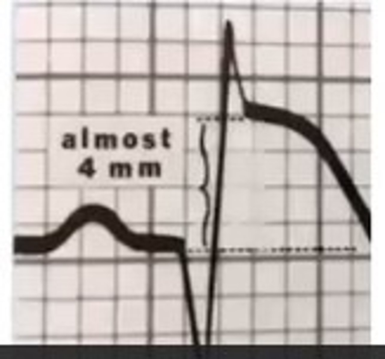 <p>D. Myocardial infarction that has an elevation of the ST segment greater than 1 mm and the PT should stop the protocol and call 911</p><p>if the elevation of ST-segment with exercise is</p><p>less than 1mm is okay</p><p>more than 1 mm is dangerous and call 911</p>