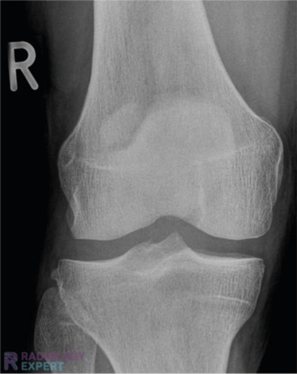 <p>what does this x-ray show</p>