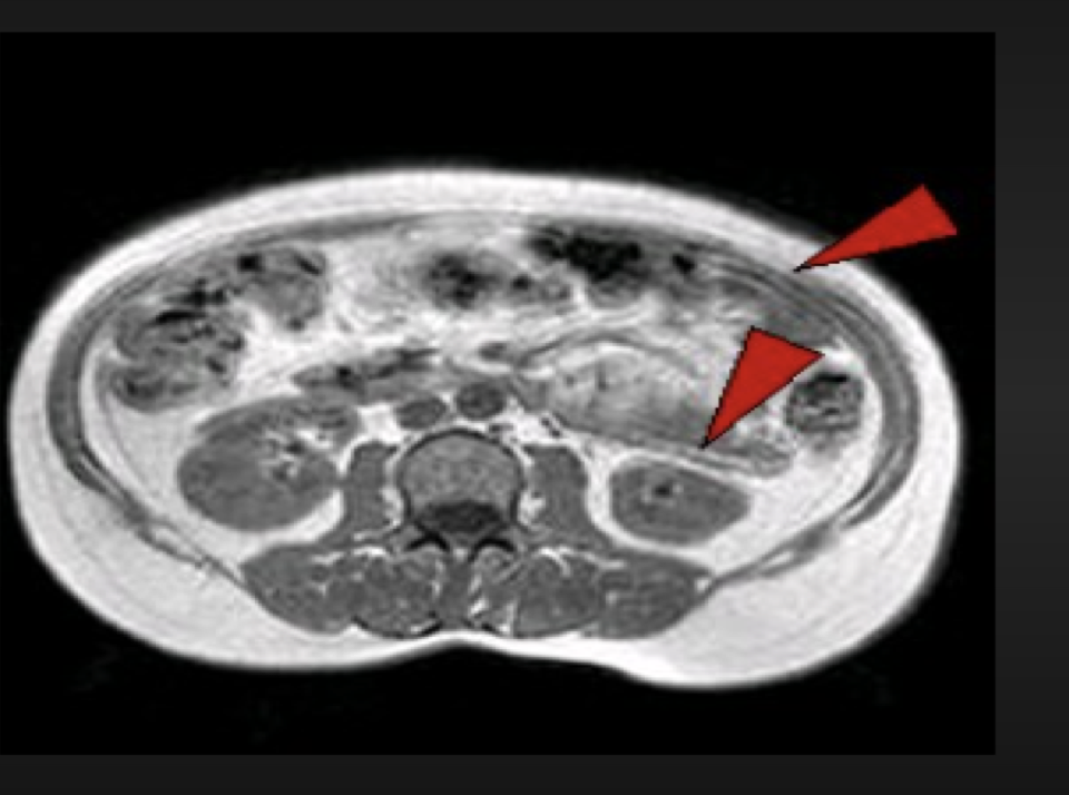 <p>anatomy that moves periodically during the scan, such as the chest wall during respiration, pulsatile movement of vessels and CSF, swallowing and eye movement</p>