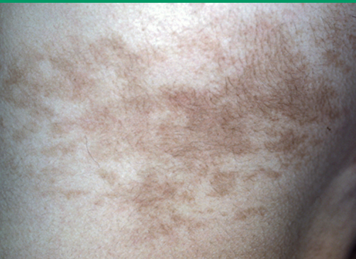 <p>what condition?</p><ul><li><p>common cutaneous hamartoma w/ epidermal or dermal elements</p></li><li><p>overgrowth of epidermis, melanocytes, and hair follicles</p></li><li><p>well-defined unilateral brown patch w/ sharply demarcated borders</p></li><li><p>macular w/ papular/verrucous surface</p></li><li><p>hypertrichosis in 50%</p></li><li><p>tx: laser therapy (q switch, pulse dye, fractional resurfacing)</p></li></ul><p></p>