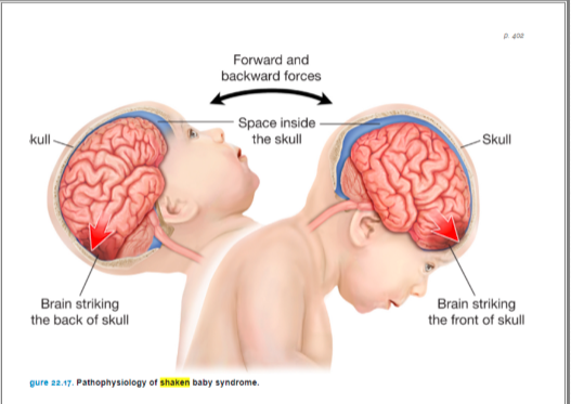 <p>#1 cause of brain damage in infants</p><p>can either be a Suspected Non-Accidental Trauma or deemed intentional or non intention</p><p>the force exerted on shaking can cause cerebral edema, hemorrhage, hydrocephalus, and retinal hemorrhage</p><p>survivors usually have permanent disabilities</p><p><span style="color: #eee5e5">Cues include vomiting, irritability, increased sleeping, seizures and apnea</span><span style="color: transparent">.</span> </p>