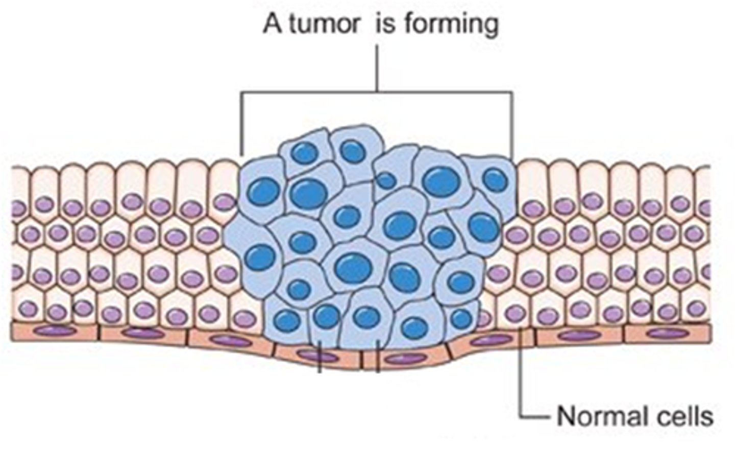 <p>Divide excessively and can invade other tissues and displace normal cells. Cannot form specialized cells as it divides too quickly. Has a larger nucleus due to excessive amounts of DNA.</p>