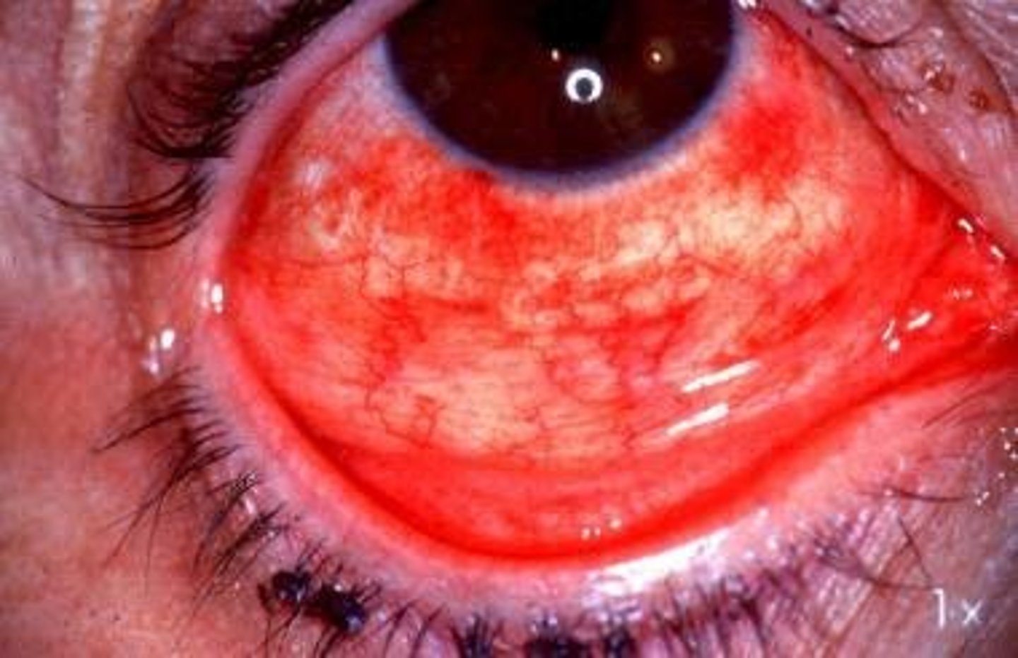 <p>inflammation of the cornea and conjunctiva</p>