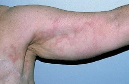 **Lymphangitis**