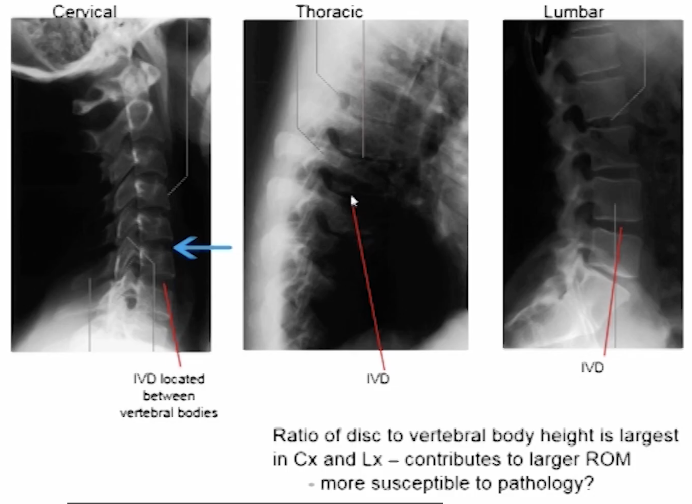 <p>It is the black space between vertebral bodies</p>