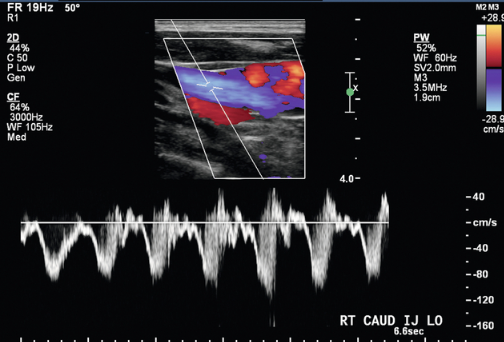 <p>In your UE venous exam, you obtain bilateral IJ waveforms as indicated in this ultrasound image. These waveforms indicate that </p>