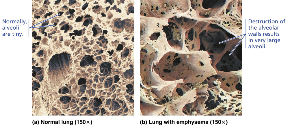 <ul><li><p><strong>CAUSE</strong></p><ul><li><p><span style="color: red;"><strong><span>Reduce the </span><u><span>alveolar surface area</span></u></strong></span></p></li></ul></li><li><p><strong>EFFECT</strong></p><ul><li><p>Walls of adjacent alveoli break down and the alveolar chambers enlarge</p></li></ul></li><li><p><strong>TREATMENT</strong></p><ul><li><p>Administering supplemental oxygen → Increase the P<sub>O2</sub> <span><span>in the alveoli to increase the diffusion of oxygen across the respiratory membrane</span></span></p></li></ul></li></ul><p> </p><p></p>