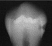 <p>classify this according to radiographic presentation of the ADA </p>