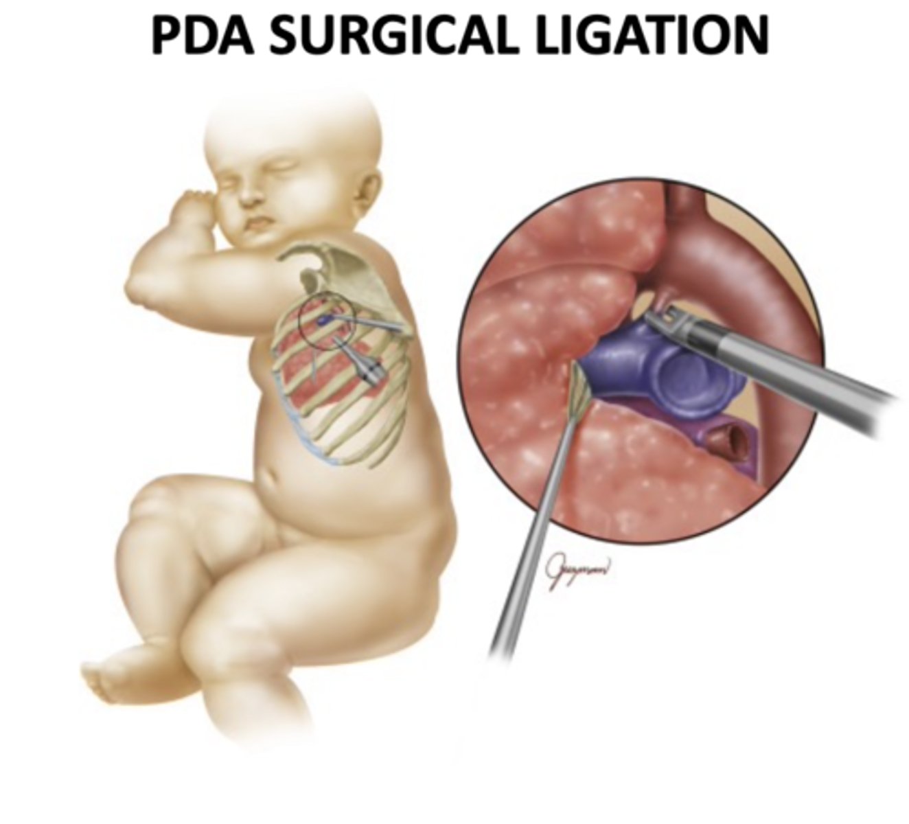 <p>Open or thoracoscopic tying/division of the ductus; current series report PDA closure rates around 94-100% with very low operative mortality (0-2%).</p>