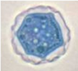 <p><strong>Identify the parasitic stage.</strong></p><ul><li><p><em>Acanthamoeba castellanii</em> cyst.</p></li></ul><div data-type="horizontalRule"><hr></div><p><strong>Mention two morphological characteristics of this stage.</strong></p><ul><li><p>About <strong>15–20 µm</strong> in size.</p></li><li><p>Has a <strong>polygonal double wall with many pores.</strong></p></li></ul><div data-type="horizontalRule"><hr></div><p><strong>Mention the possible human samples used for diagnosis, and the culture medium used.</strong></p><ul><li><p><strong>Samples:</strong> CSF, brain tissue, corneal tissue, and skin biopsy.</p></li><li><p><strong>Culture medium:</strong> Non-nutrient agar (1.5%) enriched with <em>Escherichia coli.</em></p></li></ul><div data-type="horizontalRule"><hr></div><p><strong>Mention the diagnostic methods used for ocular infection caused by this parasite.</strong></p><ol><li><p><strong>Corneal scrapings or sections</strong> examined by <strong>direct microscopy and staining</strong>, or by <strong>cultivation.</strong></p></li><li><p><strong>Laser confocal microscopy</strong> can visualize both <strong>trophozoites and cysts.</strong></p></li></ol><p></p>
