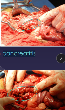 <ul><li><p><strong>Pseudocyst</strong></p><ul><li><p><span style="color: rgb(136, 136, 136);"><strong>Et: </strong></span>Sterile(fluid filled), often from pancreatitis</p></li><li><p><span style="color: rgb(136, 136, 136);"><strong>Tx: </strong></span>partial pancreatectomy, drain + omentalize(fills hole) (#1)</p></li></ul></li><li><p><strong>Insulinoma</strong></p><ul><li><p><span style="color: rgb(136, 136, 136);"><strong>Cs:</strong> </span><strong>Severe hypoglycemia</strong>, seizures, metastasis</p></li><li><p><span style="color: rgb(136, 136, 136);"><strong>Tx:</strong></span> partial pancreatectomy, excise</p><ul><li><p>metastasis 50% to liver and local lymph nodes: quickly</p><ul><li><p>run a Insulin:glucose ratio - DX</p></li></ul></li></ul></li></ul></li></ul><ul><li><p><strong>Abscess → sterile, very common&nbsp;</strong></p><ul><li><p><span style="color: rgb(136, 136, 136);"><strong>Et:</strong></span><strong> </strong>Rare, <strong>pancreatitis</strong></p></li><li><p><span style="color: rgb(136, 136, 136);"><strong>Tx:</strong></span><strong> </strong>excision, drain + omentalize, antibiotics</p></li></ul></li></ul><p></p>