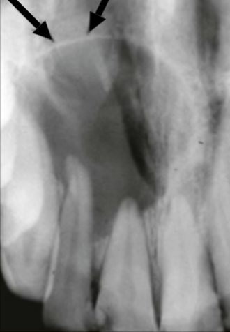 <p>Describe this Radicular Cyst</p>