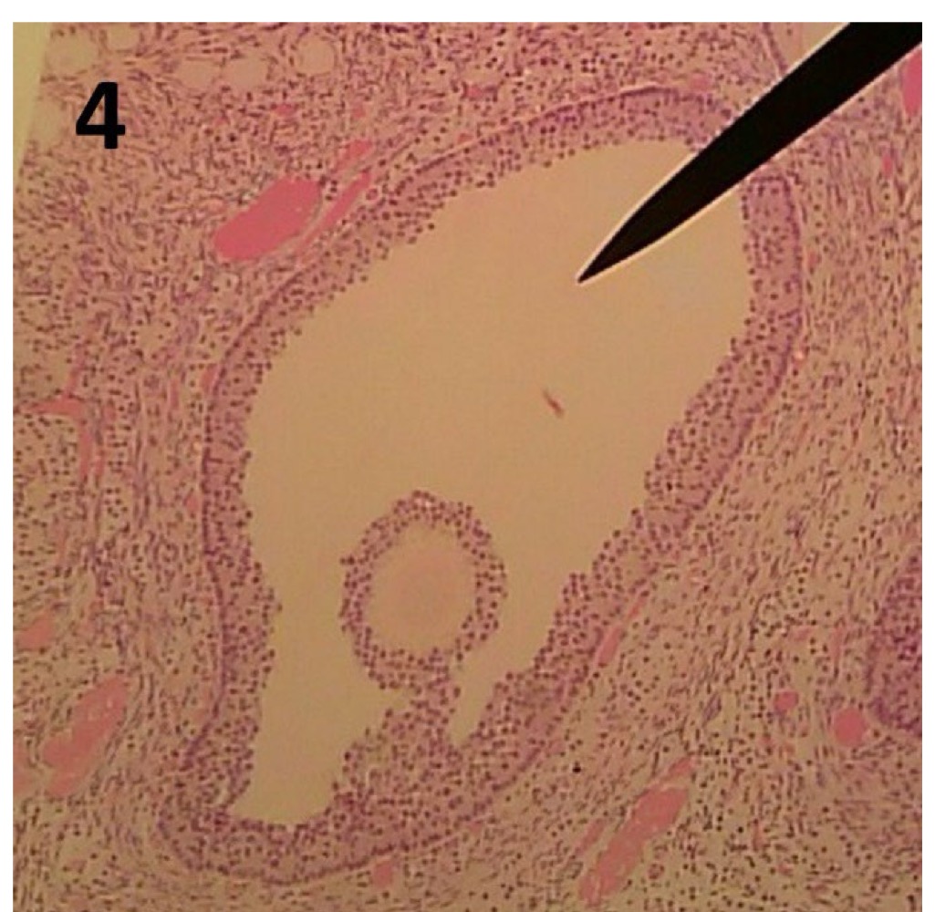 <p>Tertiary follicle</p>