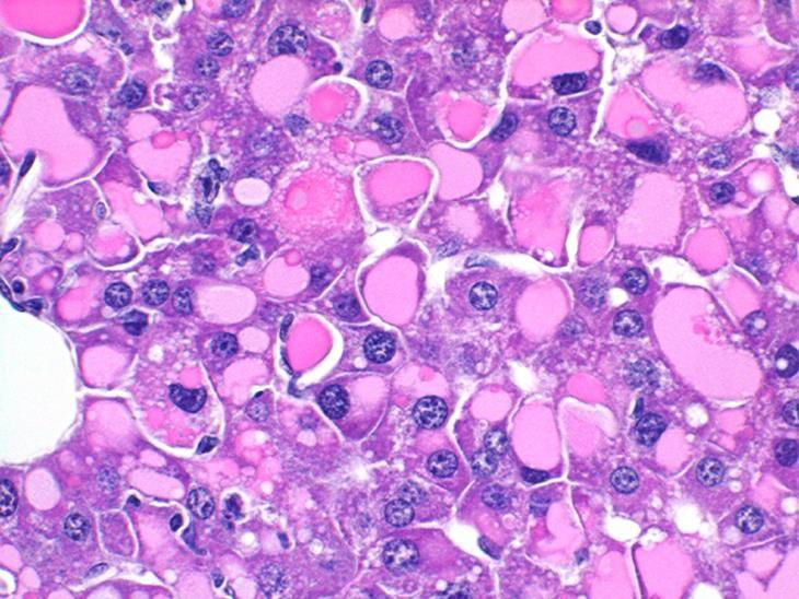 <p>This is a histological section of what cellular injury?</p>