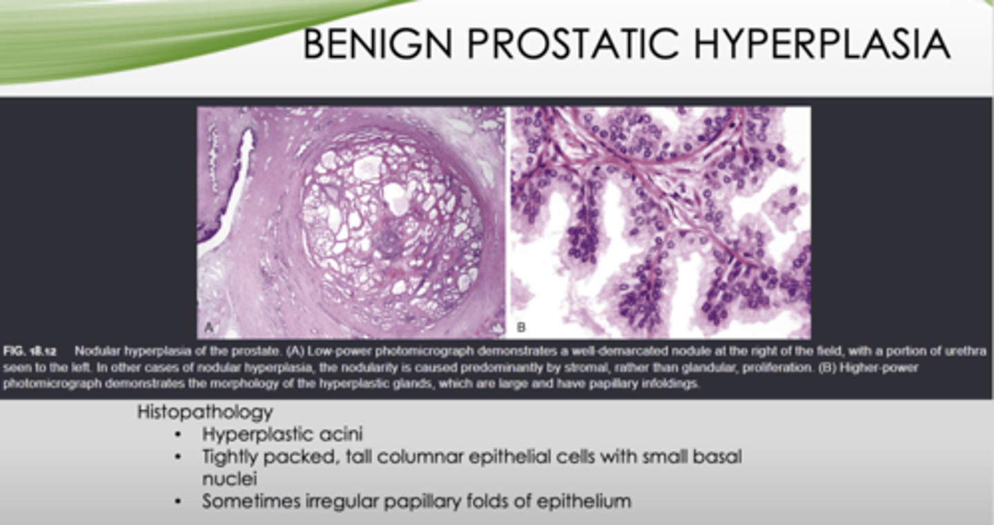 <p>BPH</p>