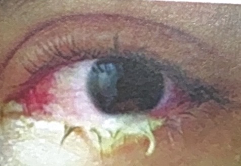 <p><u>Case Study 1</u></p><p><span>It is Saturday afternoon and Matthew Hall has asked the pharmacy assistant if he could have some eye drops as they have discharge from both eyes now for four days and is not getting better.</span></p><p><span>The pharmacy assistant has referred this request to you, as the community pharmacist.</span></p><ul><li><p><span>﻿﻿Your system shows only a single prescription 2 years ago for mebeverine 135mg tablets: 1 tablet 3 times a day</span></p></li><li><p><span>﻿﻿You have asked Matthew to come to the pharmacy consultation room. You note their eyes are generally red and that there is some sticky discharge in both corners</span></p></li></ul><p></p>