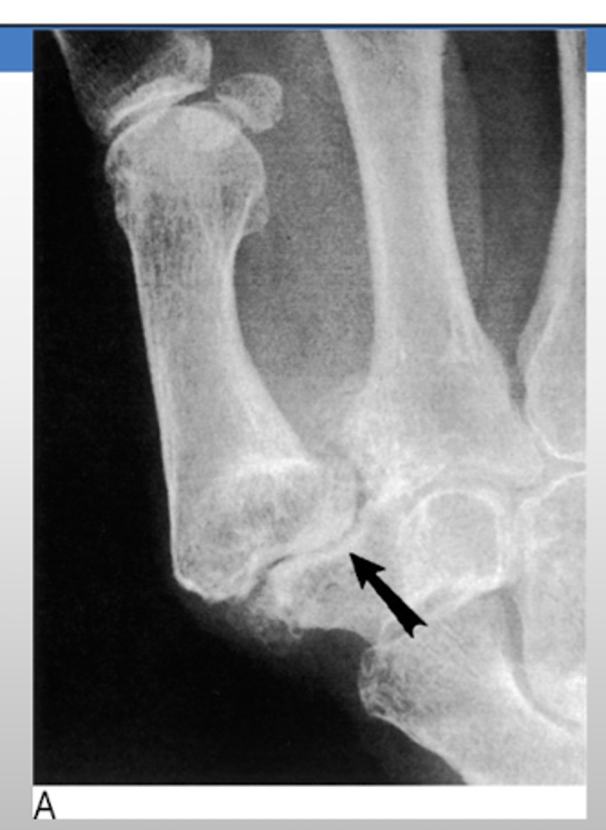<p>base of the thumb</p>
