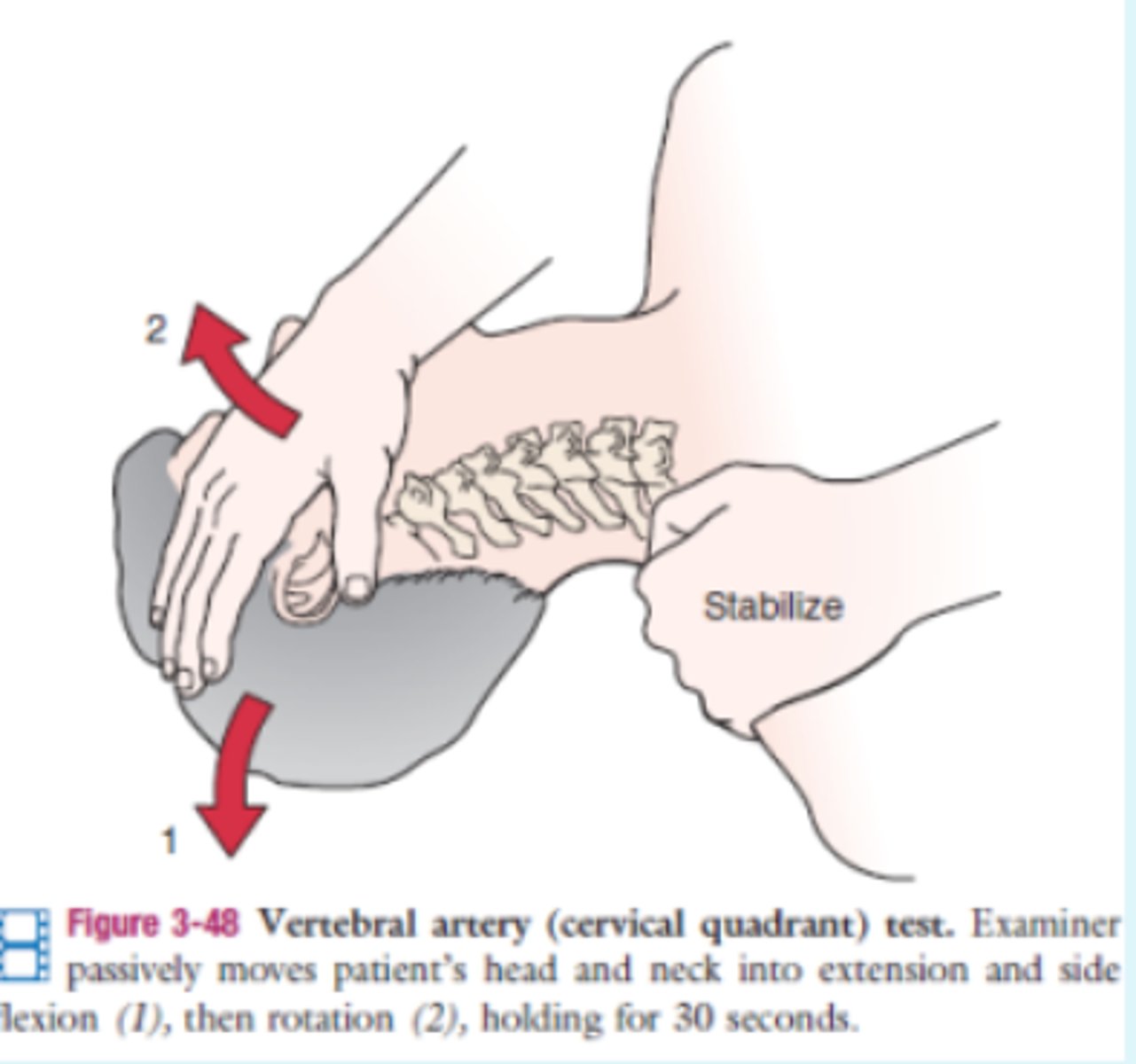 <p>- vertebrobasilar vascular</p><p>(+): symptoms if the opposite artery is affected</p>