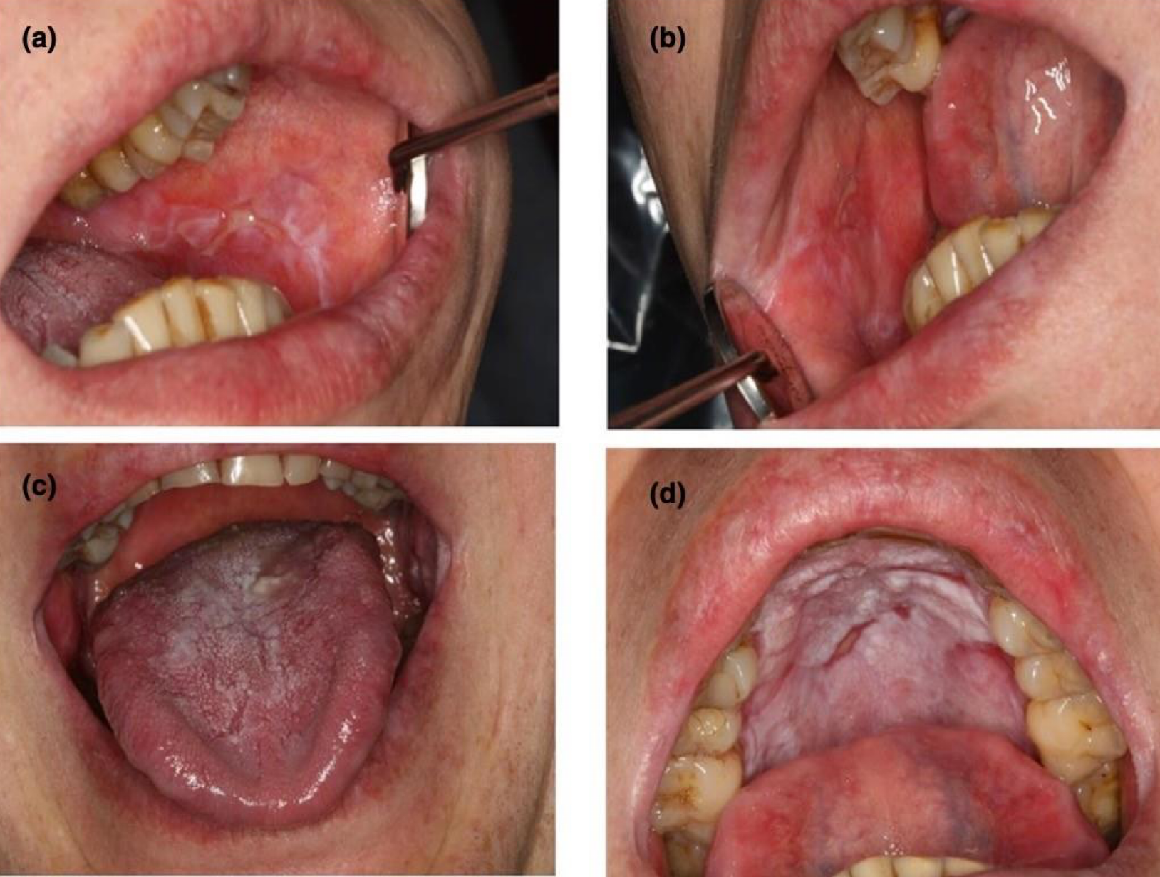 <p>which autoimmune/immune-mediated/allergic lesion:</p>