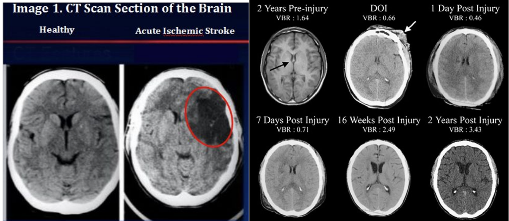 <p>● Identifies lesion site </p><p>● X-rays </p><p>● CT or CAT scans </p><p>● MRI–Magnetic Resonance Imaging </p><p>● Carotid ultrasound </p><p>● Cerebral angiography </p><p>● Doppler ultrasound</p>