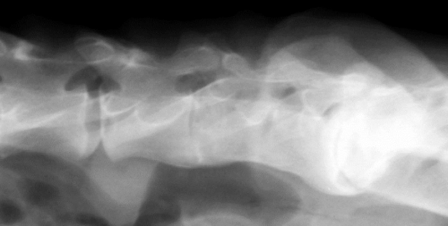 <p>False, usually insignificant, but can add stress to the adjacent disc space</p>