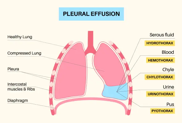 <p>Effusion </p>