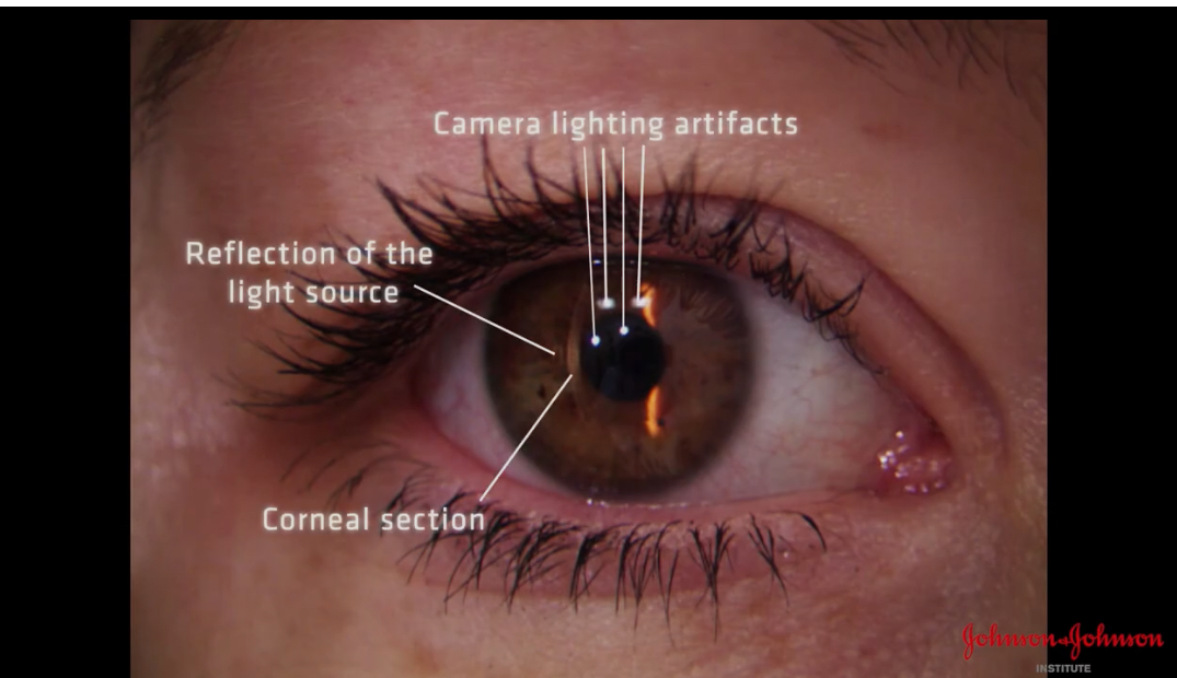 <p>Corneal section formed </p><p>Microscope in straight ahead direction </p><p>Can see reflection of light source to the left of section </p>