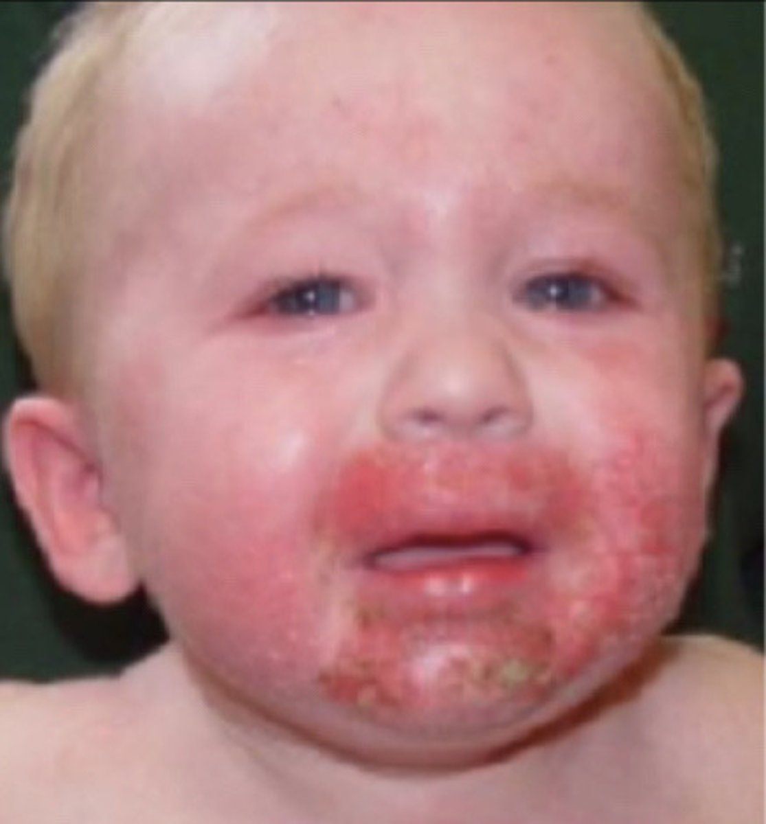 <p>Cheeks, perioral, wrists, extensor arms and legs</p>