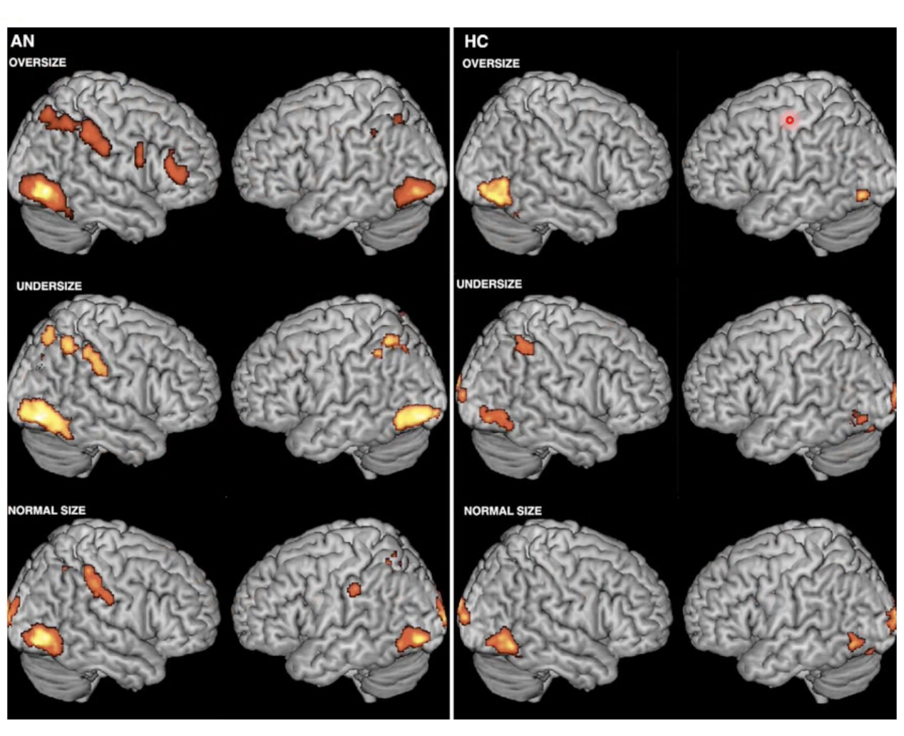 <p>Compared fMRI images been people with anorexia and HCs when viewing altered images of themselves with different body weights</p><ul><li><p>There was an elevated neural response in attentive, executive and self-evaluation networks in the brain for people with AN</p></li><li><p>ESPECIALLY when they viewed themself in the overweight condition</p></li><li><p>Everyone seemed to follow the same pattern of escalation with increase in body weight, but AN Px were stronger</p></li></ul><p>Takeaway: A pathological neural response exists for people with AN which contributes to distorted body image through visual processing</p><p></p>