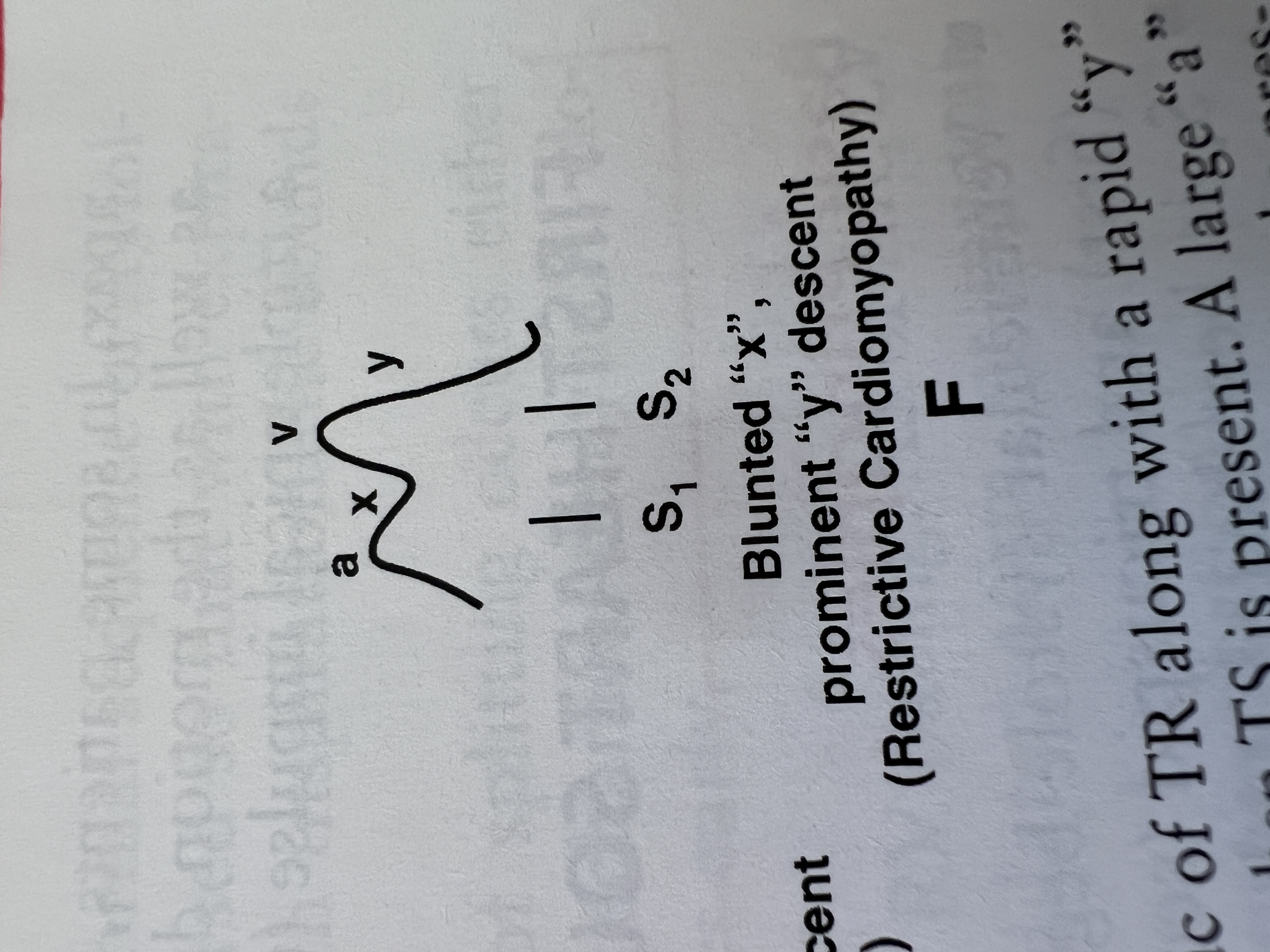 <p>What heart condition is indicated by a blunted 'x' descent with a rapid 'y' descent?</p>