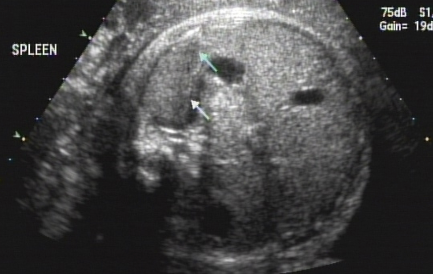 <ul><li><p>DIfficult to image - Not routinely imaged, but can be visualized after 18 weeks</p></li><li><p><strong>Homogeneous texture similar</strong> to the <span style="color: rgb(0, 118, 255);">kidneys</span>, <strong>less echogenic</strong> than the <span style="color: rgb(0, 118, 255);">liver</span></p></li><li><p>best imaged in the <span style="color: rgb(255, 0, 255);">transverse plane</span></p></li><li><p><span style="color: rgb(255, 0, 255);">posterior</span> and to the<span style="color: rgb(255, 0, 255);"> left</span> of the <span style="color: rgb(0, 118, 255);">fetal stomach</span></p></li></ul><p></p>