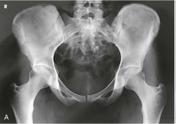 <p>AP Projection; Pelvis and Proximal Femora</p>