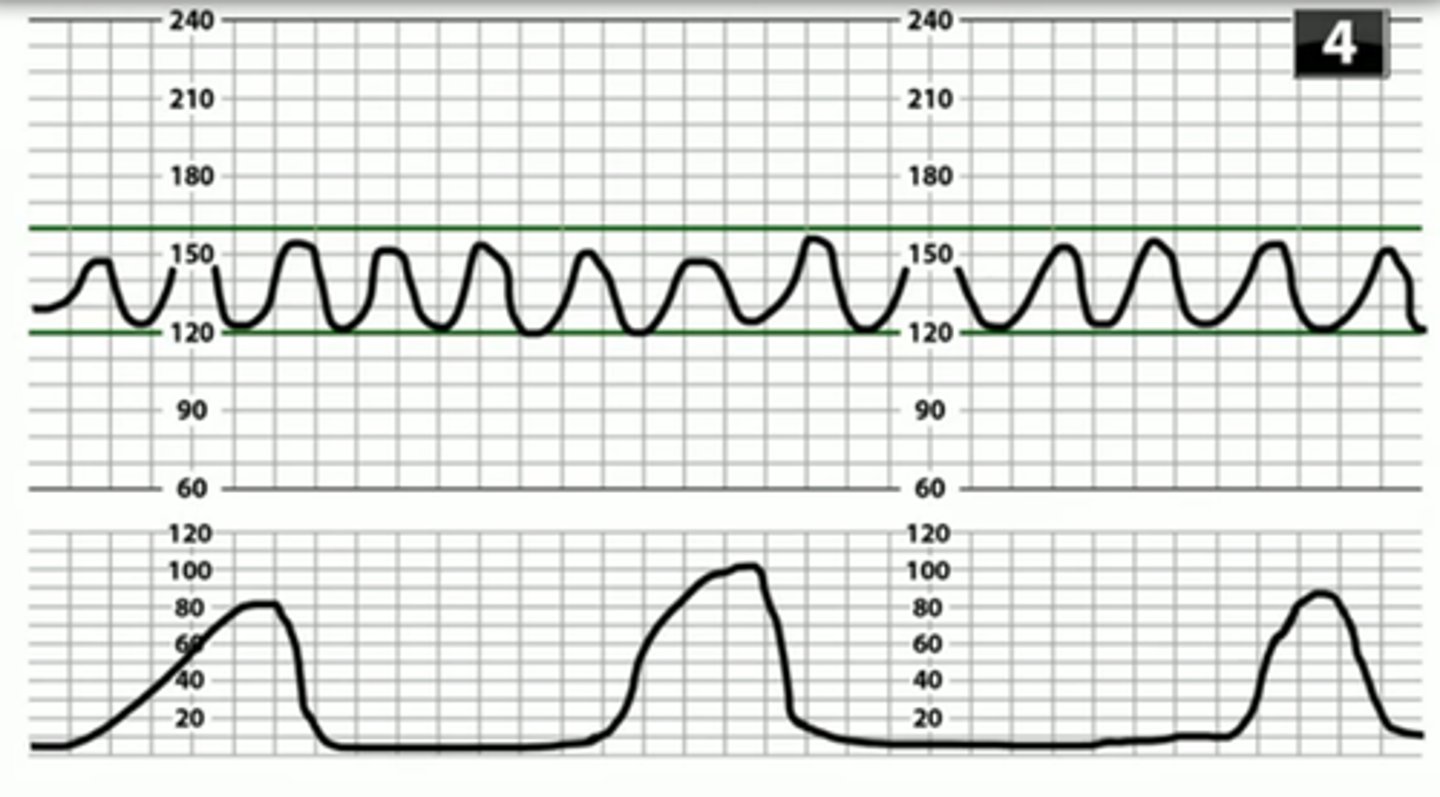 <p>Smooth wave-like pattern of regular frequency and amplitude</p><p>Rare &amp; ominous FHR pattern - Category III</p>