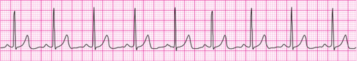 <p>Normal sinus rhythm</p>