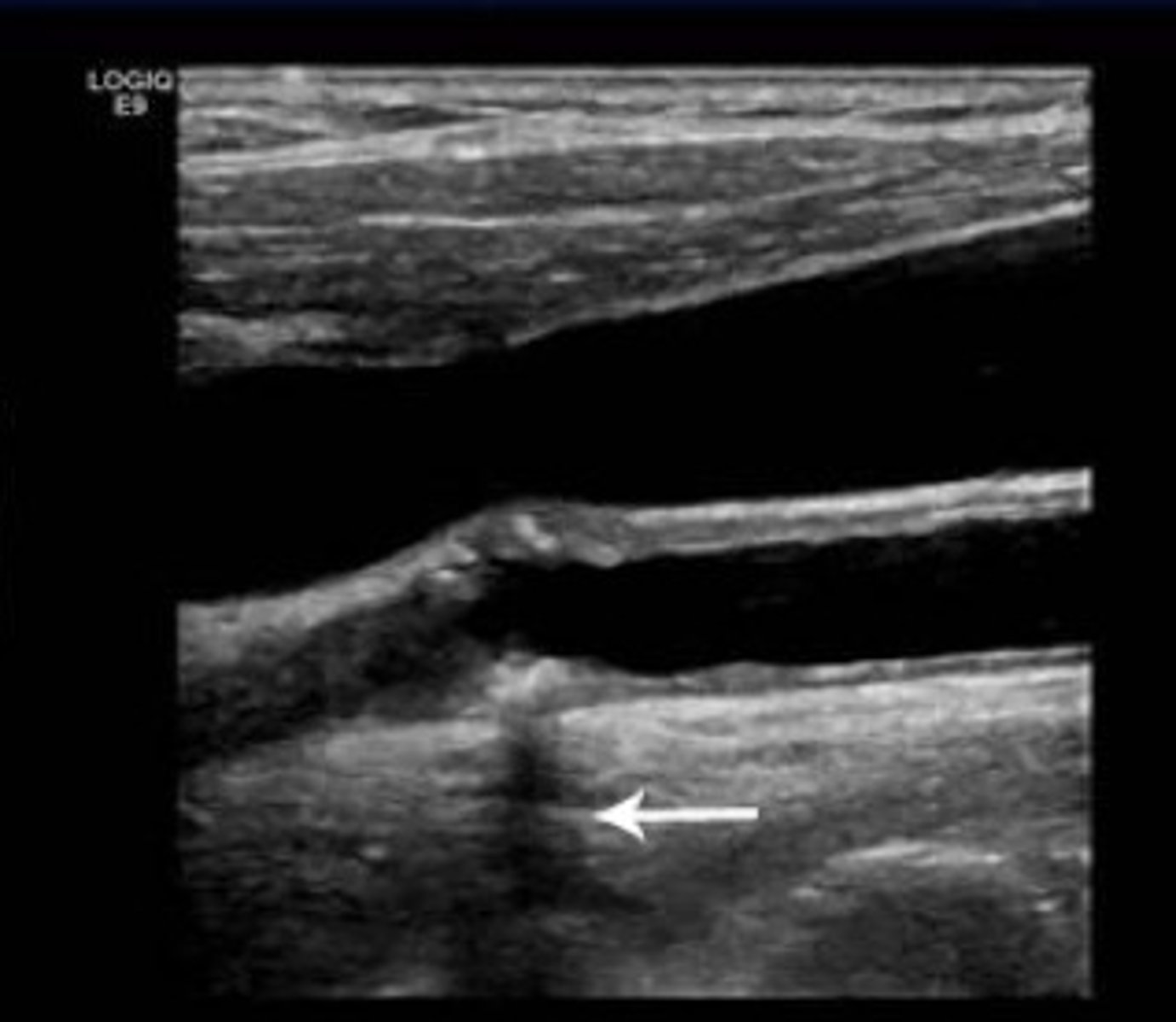 <p>Reduction in signal amplitude in tissue distal to a highly attenuating or reflecting object</p>