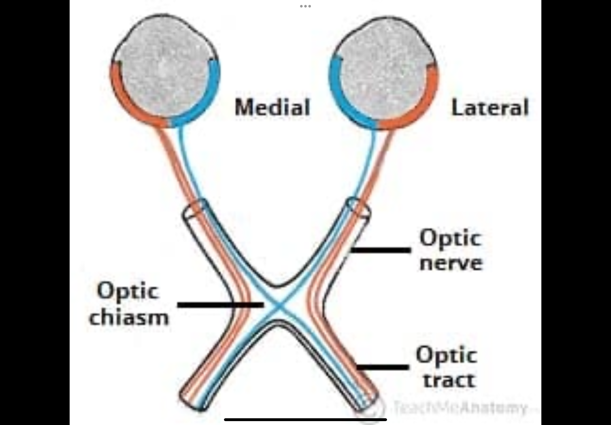 <p>1. Retina</p><p>2. Optic nerve</p><p class="p1">3. Optic chiasm — nasal fibres cross; temporal do not</p><p class="p1">4. Optic tract</p><p class="p1">5. Lateral geniculate nucleus (LGN)</p><p class="p1">6. Optic radiations</p><p class="p1">7. Primary visual cortex (V1 / area 17)</p><p class="p1">• Branches to brainstem nuclei controlling eye movements</p><p class="p1"></p><p class="p1">Retina (signal origin)</p><ul><li><p>Photoreceptors (rods and cones) detect light.</p></li><li><p>Signals are processed locally by bipolar and ganglion cells.</p></li><li><p>Ganglion cell axons leave the eye as the optic nerve.</p></li><li><p>Each retina is divided into:</p><ul><li><p>Nasal retina (medial half)</p></li><li><p>Temporal retina (lateral half)</p></li></ul></li></ul><p></p><p>Optic nerve</p><ul><li><p>Made of nerve fibres from the retina of one eye.</p></li><li><p>Carries visual signals from that eye toward the brain.</p></li><li><p>Contains fibres from both halves of the retina:<br></p><ul><li><p>Nasal retina fibres</p></li><li><p>Temporal retina fibres</p></li></ul></li></ul><ul><li><p>No fibres have crossed yet at this stage.</p></li></ul><p></p><p>Optic chiasm (where crossing happens)</p><ul><li><p>Some nerve fibres physically switch sides here.</p></li><li><p>Nasal retinal fibres cross to the opposite side of the brain.</p></li><li><p>Temporal retinal fibres stay on the same side.</p></li><li><p>This sorting makes sure:<br></p><ul><li><p>Information from the left side of the world goes to the right brain</p></li><li><p>Information from the right side of the world goes to the left brain</p></li></ul></li></ul><p></p><p>Optic tract</p><ul><li><p>Forms after the optic chiasm.</p></li><li><p>Each optic tract now carries information from:<br></p><ul><li><p>Both eyes</p></li><li><p>But only one side of the visual field</p></li></ul></li></ul><p></p><ul><li><p>Right optic tract carries the left visual field.</p></li><li><p>Left optic tract carries the right visual field.</p></li></ul><p></p><ul><li><p>Fibres now represent both eyes, but only one visual field.</p></li></ul><p></p><p></p><p>Lateral geniculate nucleus (LGN)</p><ul><li><p>Located in the thalamus.</p></li><li><p>Major synaptic relay station.</p></li><li><p>Receives optic tract fibres and organises visual information.</p></li><li><p>Maintains precise retinotopic mapping.</p></li><li><p>Modulates signals before sending them to cortex.</p></li></ul><p></p><p>Optic radiation</p><ul><li><p>Axons leaving the LGN.</p></li><li><p>Fan out toward the occipital lobe.</p></li><li><p>Carry visual information to the cortex.</p></li><li><p>Upper and lower visual field information travel in different bundles.</p></li></ul><p></p><p></p><p>Primary visual cortex (V1 / area 17)</p><ul><li><p>Located in the occipital lobe.</p></li><li><p>First cortical site of visual processing.</p></li><li><p>Receives a complete, mapped representation of the visual field.</p></li><li><p>Begins processing of orientation, edges, and spatial detail.</p></li></ul><p></p><p>Brainstem branch (non-conscious pathways)</p><ul><li><p>Some optic tract fibres diverge before the LGN.</p></li><li><p>Project to brainstem nuclei.</p></li><li><p>Involved in:<br></p><ul><li><p>Eye movements</p></li><li><p>Pupillary light reflex</p></li><li><p>Visual attention and coordination</p></li></ul></li></ul><p></p><ul><li><p>These pathways do not produce conscious vision.</p></li></ul><p></p><p></p><ul><li><p>Retina → optic nerve → optic chiasm (nasal fibres cross) → optic tract → LGN → optic radiation → primary visual cortex, with side branches to brainstem for reflexes.</p></li></ul><p></p>