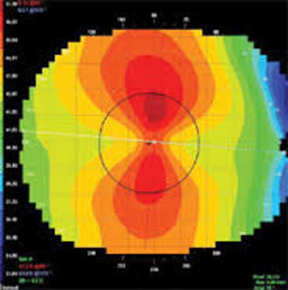 <p>A condition in which the steepest corneal meridian is in the vertical plane, an example of keratometer reading for a patient exhibiting this condition would be:</p><p>K's: 42.00 @ 180/45.00 @ 90</p>